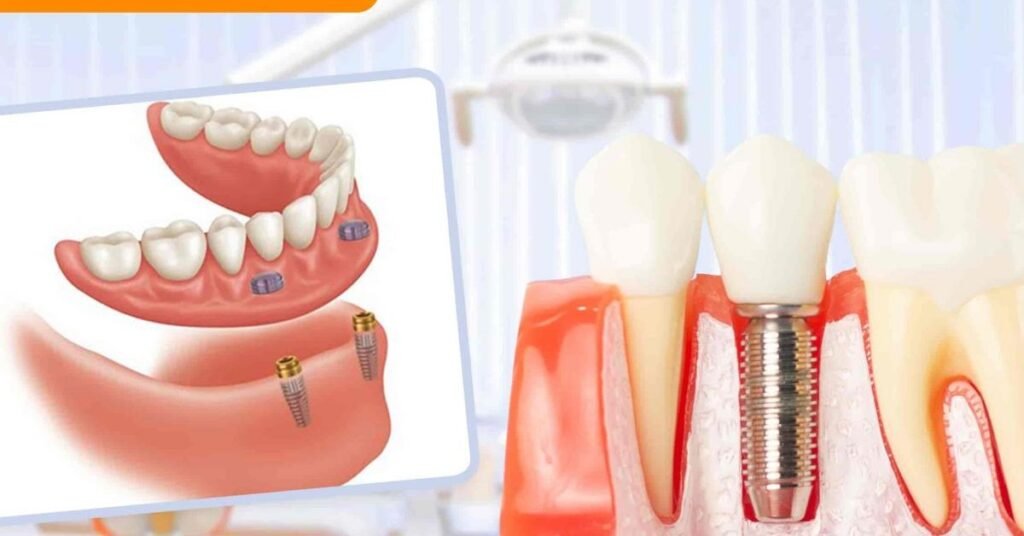 Tuổi Thọ Implant Răng tại Nha Khoa Dr. Tường Smile