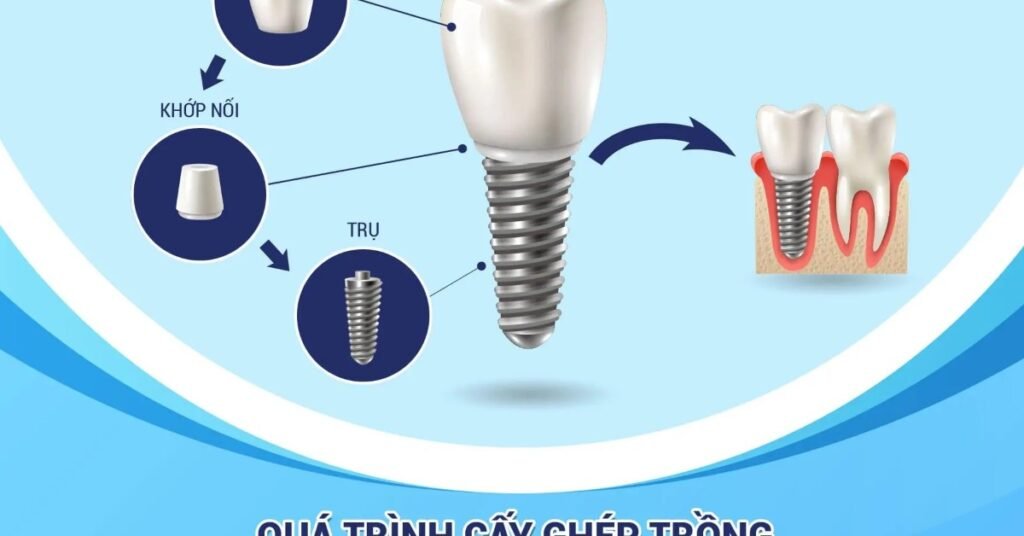 Quy Trình Cấy Ghép Răng Implant tại Nha Khoa Dr. Tường Smile
