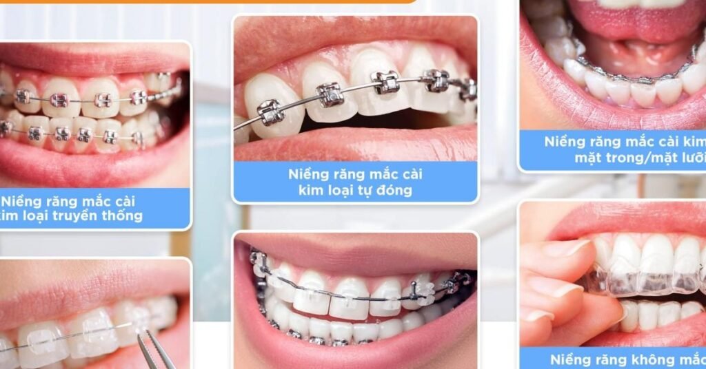Niềng Răng Cho Người Lớn tại Nha Khoa Dr. Tường Smile