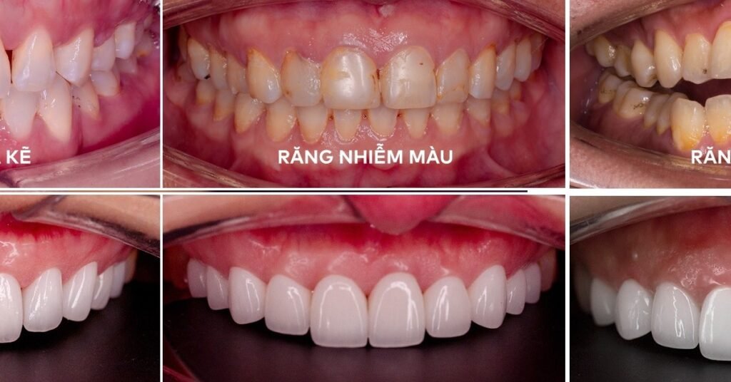 Veneer Sứ Hay Composite tại Nha Khoa Dr. Tường Smile