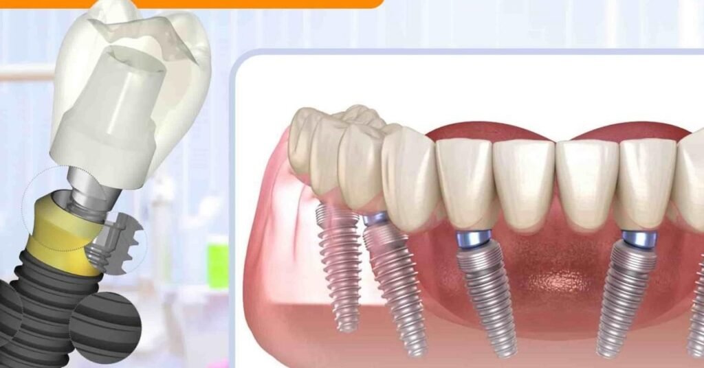 Chi Phí Cấy Ghép Răng Implant 2026 tại Nha Khoa Dr. Tường Smile