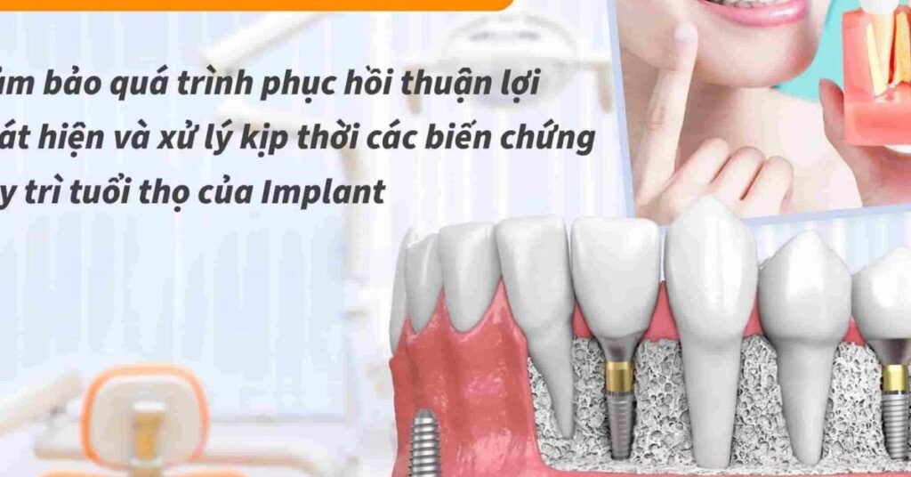 Sau Khi Cấy Ghép Implant tại Nha Khoa Dr. Tường Smile