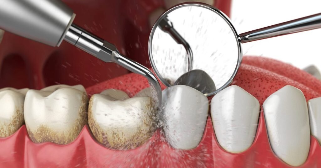 Nhổ Răng Khôn tại Nha Khoa Dr. Tường Smile