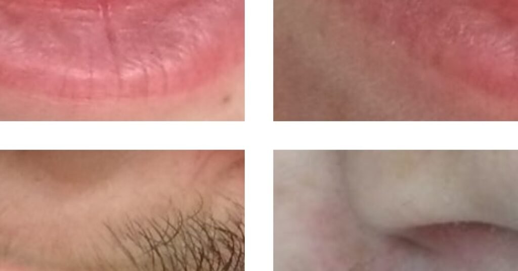Cấy Xương Trước Khi Trồng Implant tại Nha Khoa Dr. Tường Smile