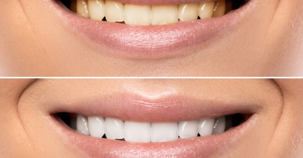 Bọc Răng Sứ Zirconia tại Nha Khoa Dr. Tường Smile