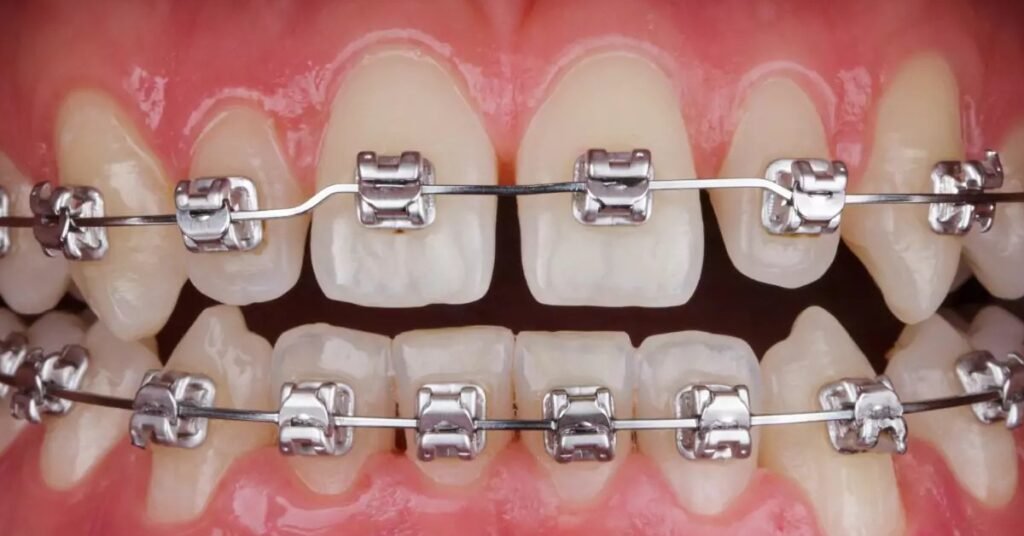 Thời Gian Niềng Răng Mất Bao Lâu? Các Yếu Tố Ảnh Hưởng Đến Tiến Trình Điều Trị tại Nha Khoa Dr. Tường Smile