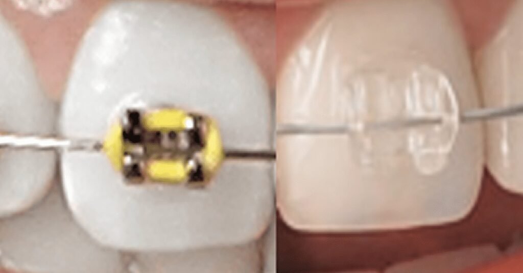 Niềng Răng Và Tâm Lý tại Nha Khoa Dr. Tường Smile