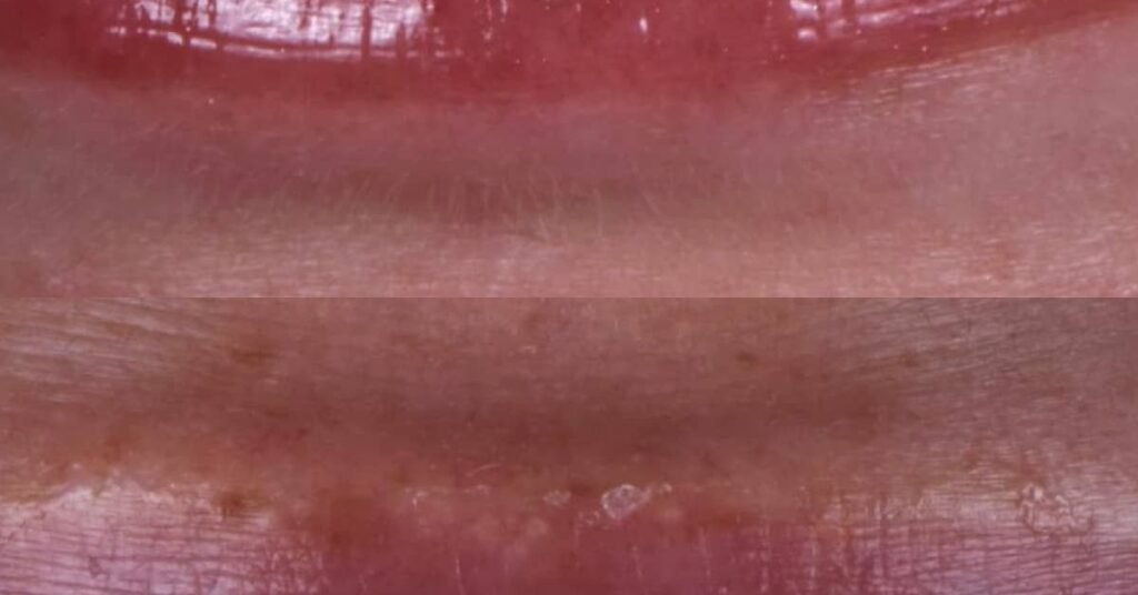 Các Loại Veneer Sứ Phổ Biến tại Nha Khoa Dr. Tường Smile