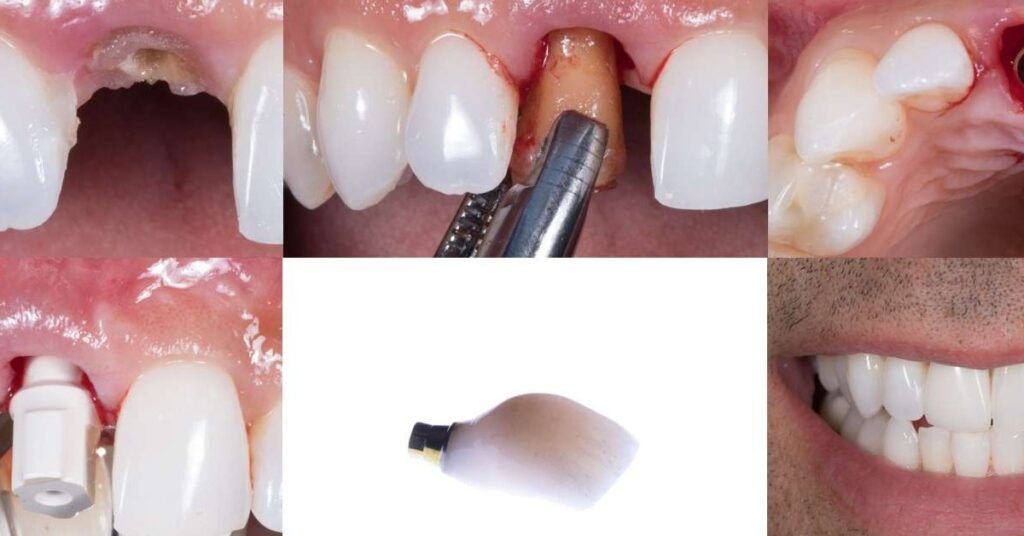 Hồi Phục Sau Khi Trồng Implant Răng tại Nha Khoa Dr. Tường Smile