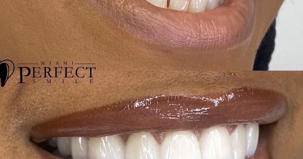 Bọc Răng Sứ tại Nha Khoa Dr. Tường Smile