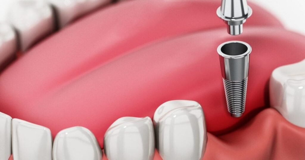 Dấu Hiệu Bạn Cần Trồng Implant Răng tại Nha Khoa Dr. Tường Smile