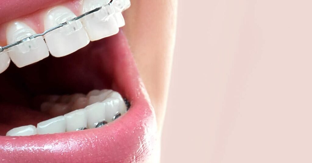 Chi Phí Niềng Răng tại Nha Khoa Dr. Tường Smile