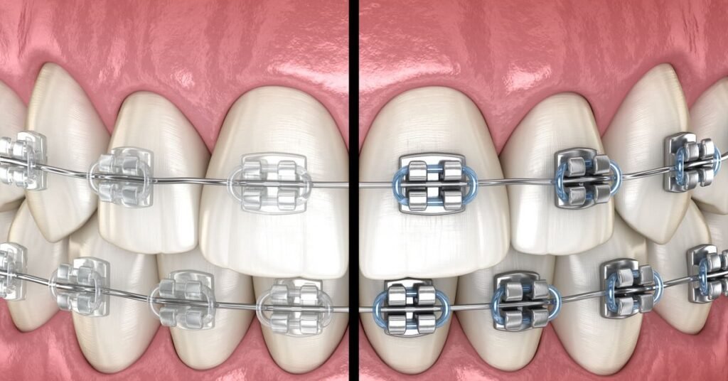 Dấu Hiệu Cho Thấy Bạn Cần Niềng Răng tại Nha Khoa Dr. Tường Smile