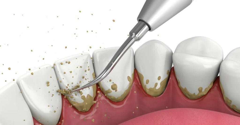 Chăm Sóc Sau Khi Nhổ Răng tại Nha Khoa Dr. Tường Smile